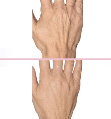 Hand Rejuvenation with PRP and /or Hyaluronic acid: