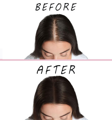 PRP Hair Rejuvenation