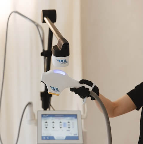 BBL® HEROic™ treatments for pigmentation, redness, sun damage, and overall skin quality, offered by Runway Aesthetics in Sidney, BC.